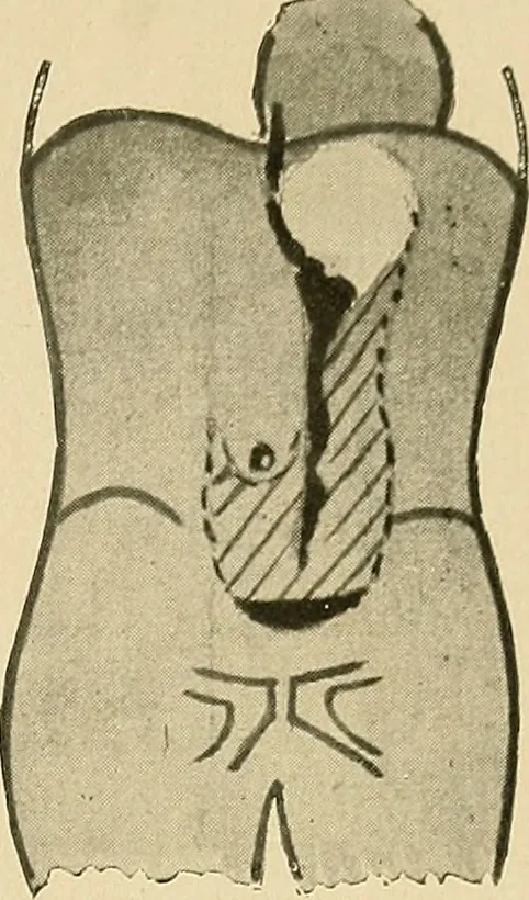 An illustration from The alimentary tract : a radiographic study, 1915, leaf 94