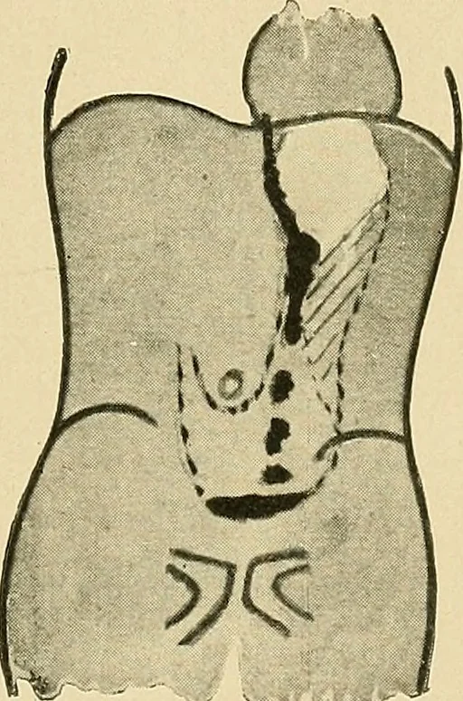 An illustration from The alimentary tract : a radiographic study, 1915, leaf 94