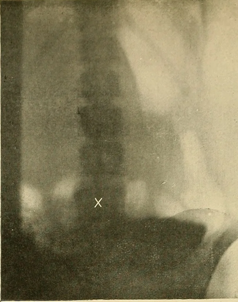 An illustration from The alimentary tract : a radiographic study, 1915, leaf 97