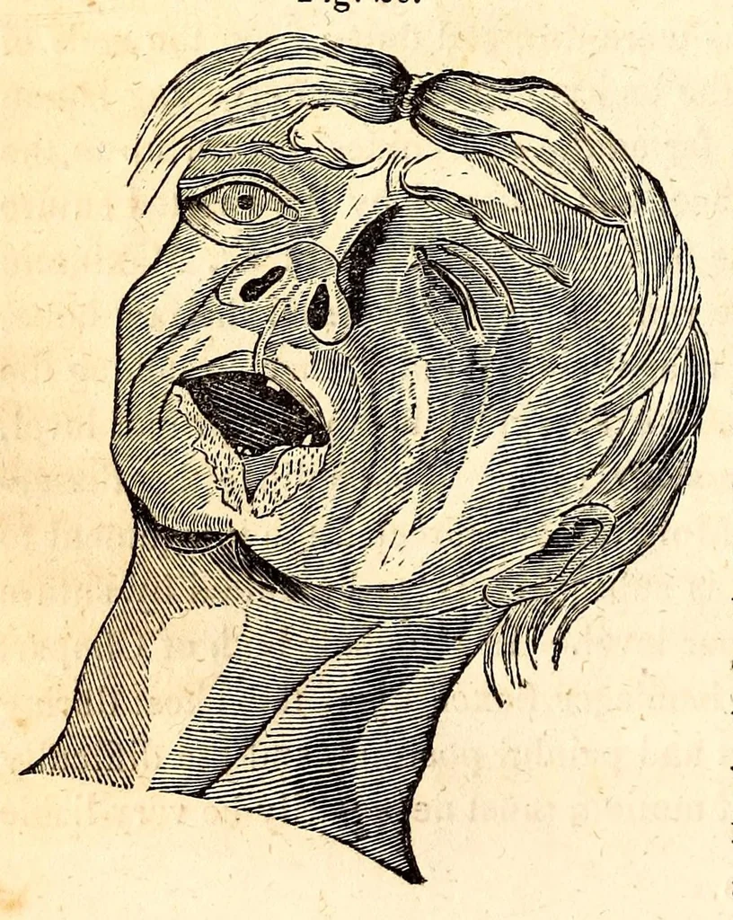 An illustration from The American journal of the medical sciences, 1827, leaf 112