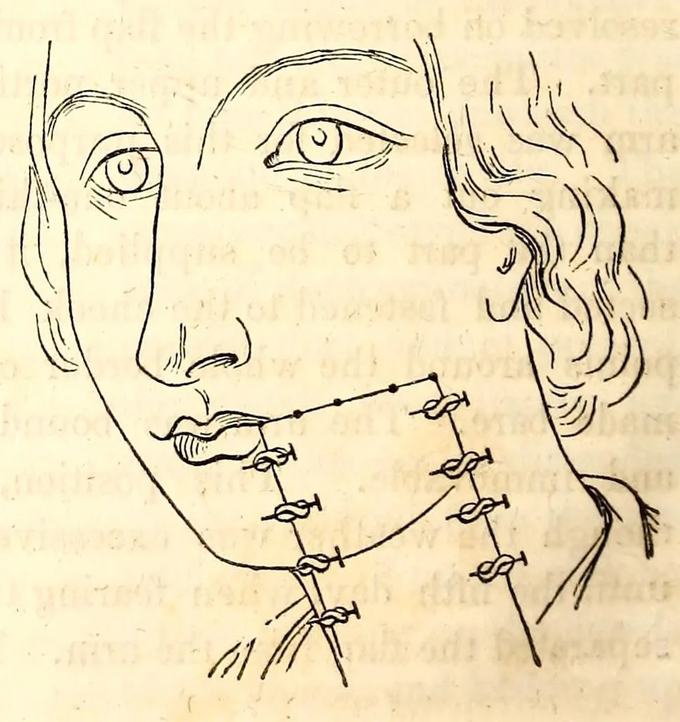 An illustration from The American journal of the medical sciences, 1827, leaf 342