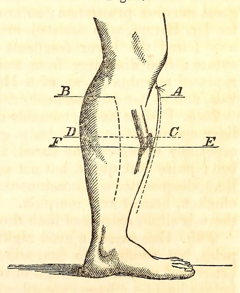 An illustration from The American journal of the medical sciences, 1827, leaf 101