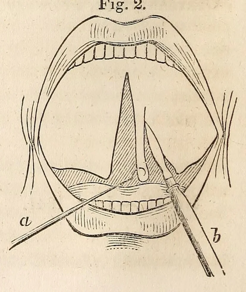 An illustration from The American journal of the medical sciences, 1827, leaf 78