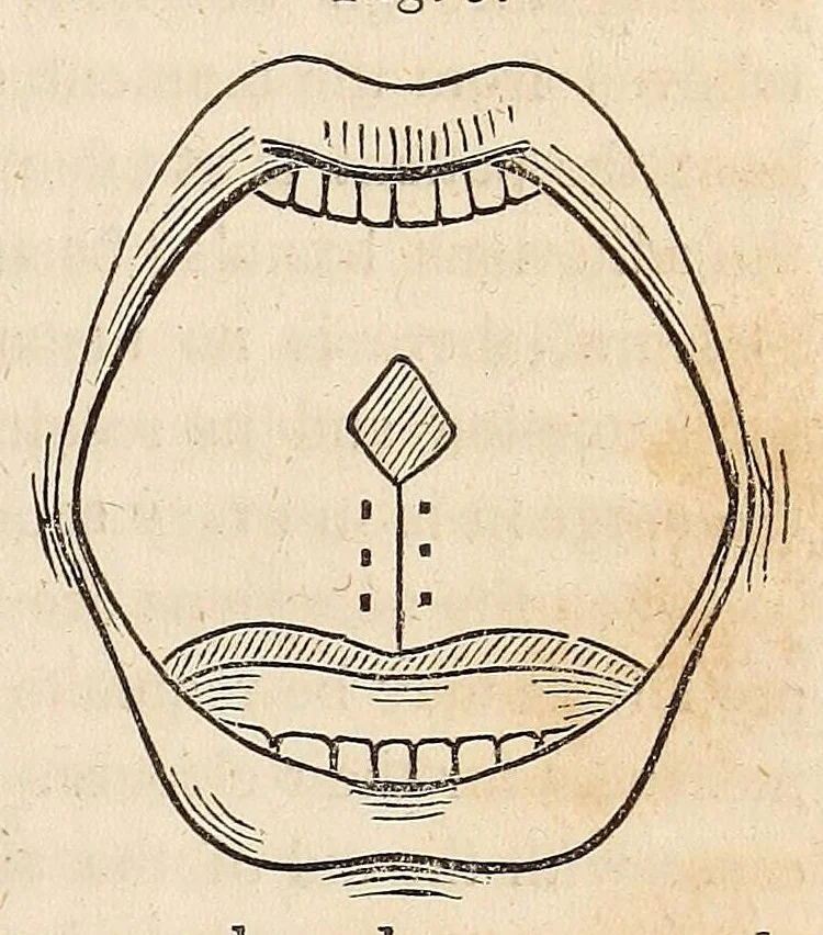 An illustration from The American journal of the medical sciences, 1827, leaf 87