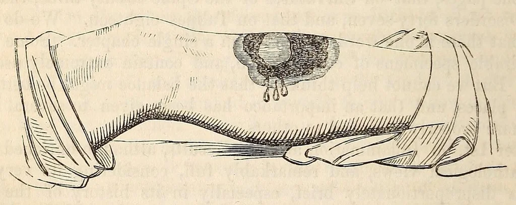 An illustration from The American journal of the medical sciences, 1827, leaf 454