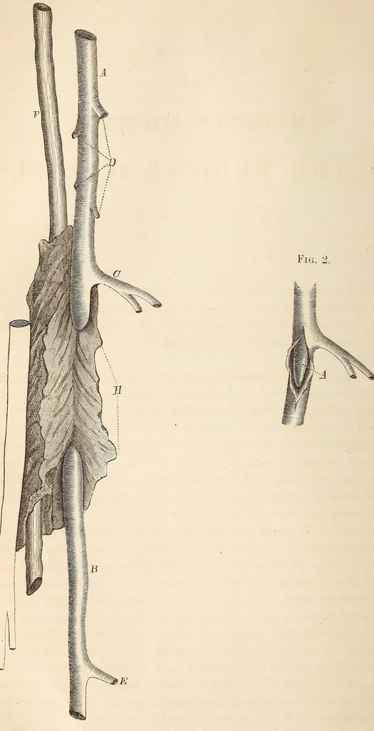 An illustration from The American journal of the medical sciences, 1827, leaf 314