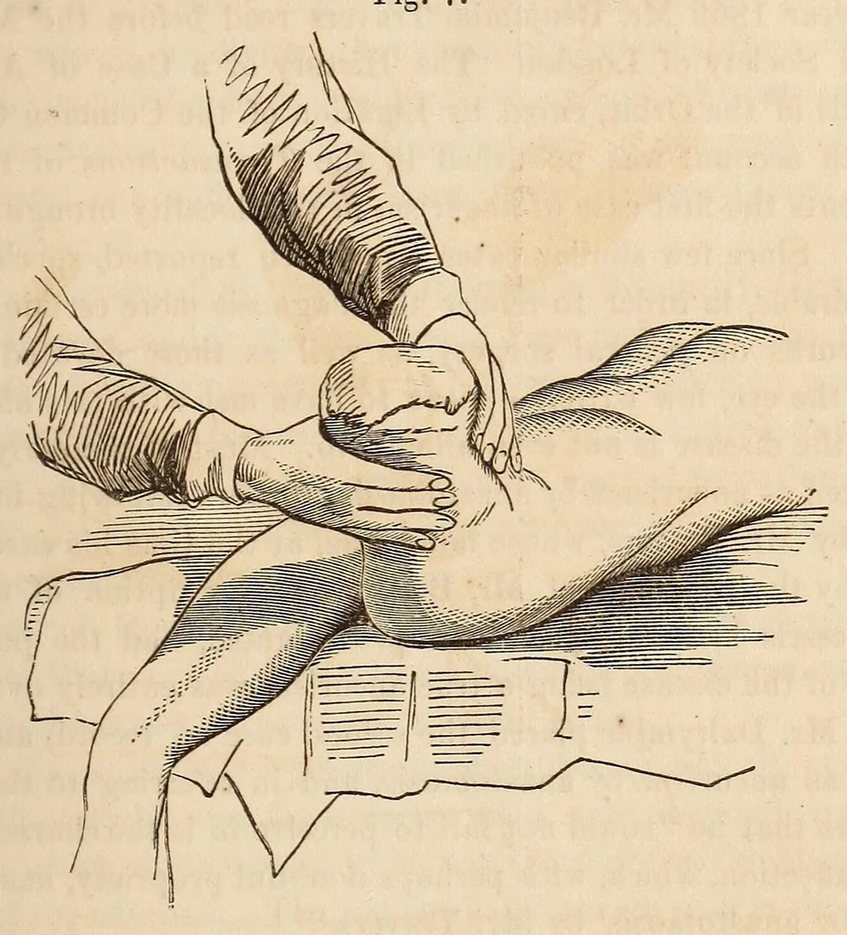 An illustration from The American journal of the medical sciences, 1827, leaf 317