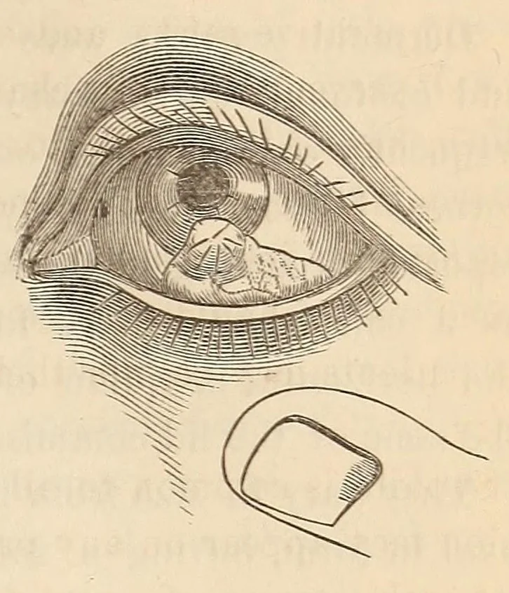 An illustration from The American journal of the medical sciences, 1827, leaf 115