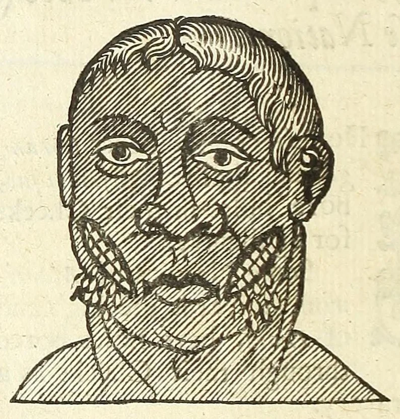 An illustration from Anthropometamorphosis: man transform'd: or, The artificiall changling, historically presented, in the mad and cruel gallantry, foolish bravery, ridiculous beauty, filthy finenesse, and loathsome loveliness of most nations, fashioning and altering their bodies from the mould intended by nature; with figures of those transformations. To which artificial and affected deformations are added, all the native and national monstrosities that have appeared to disfigure the humane fabrick. With a vindication of the regular beauty and honesty of nature, 1653, leaf 222