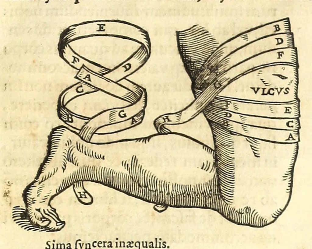 An illustration from Galeni librorum septima classis : curativum methodum tum diffuse tum breviter descriptam, victus rationem in morbis acutis, singulorum morborum facile paranda remedia, privatam quorundam morborum curationem, chirurgie constitutionem, fracturarum ac luxationum sanationem, fasciarum deniq ; & laqueorum & machinamentorum tractatum continet, 1576, leaf 433