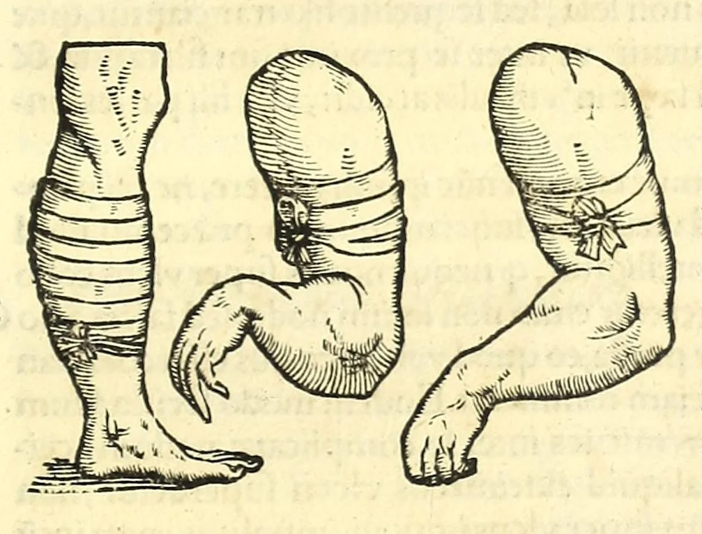 An illustration from Galeni librorum septima classis : curativum methodum tum diffuse tum breviter descriptam, victus rationem in morbis acutis, singulorum morborum facile paranda remedia, privatam quorundam morborum curationem, chirurgie constitutionem, fracturarum ac luxationum sanationem, fasciarum deniq ; & laqueorum & machinamentorum tractatum continet, 1576, leaf 435