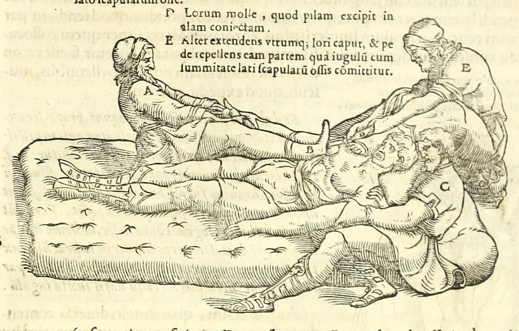 An illustration from Galeni librorum septima classis : curativum methodum tum diffuse tum breviter descriptam, victus rationem in morbis acutis, singulorum morborum facile paranda remedia, privatam quorundam morborum curationem, chirurgie constitutionem, fracturarum ac luxationum sanationem, fasciarum deniq ; & laqueorum & machinamentorum tractatum continet, 1576, leaf 529