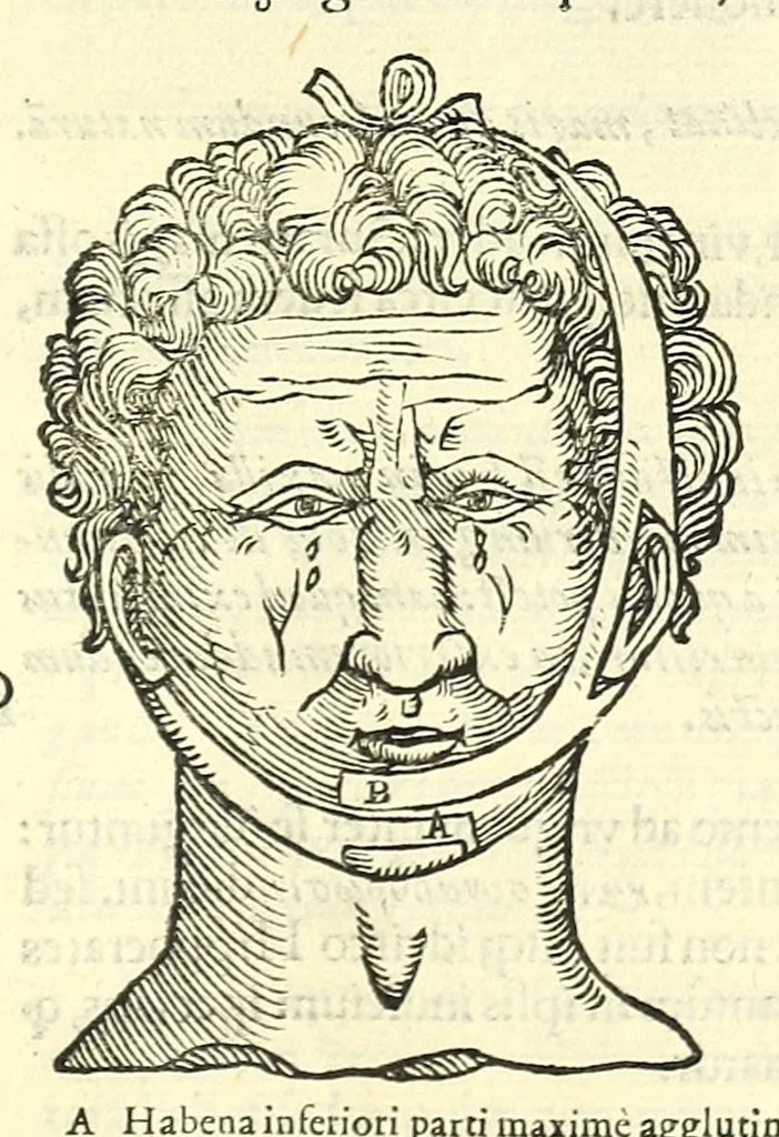 An illustration from Galeni librorum septima classis : curativum methodum tum diffuse tum breviter descriptam, victus rationem in morbis acutis, singulorum morborum facile paranda remedia, privatam quorundam morborum curationem, chirurgie constitutionem, fracturarum ac luxationum sanationem, fasciarum deniq ; & laqueorum & machinamentorum tractatum continet, 1576, leaf 551
