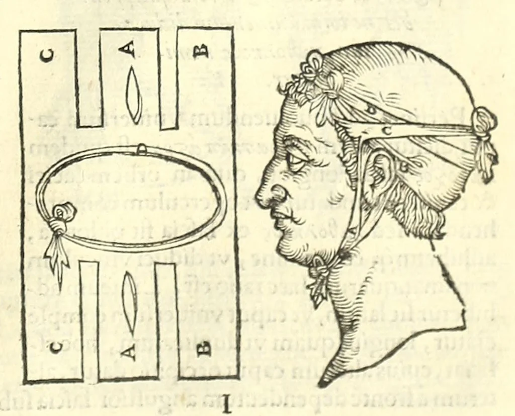 An illustration from Galeni librorum septima classis : curativum methodum tum diffuse tum breviter descriptam, victus rationem in morbis acutis, singulorum morborum facile paranda remedia, privatam quorundam morborum curationem, chirurgie constitutionem, fracturarum ac luxationum sanationem, fasciarum deniq ; & laqueorum & machinamentorum tractatum continet, 1576, leaf 609