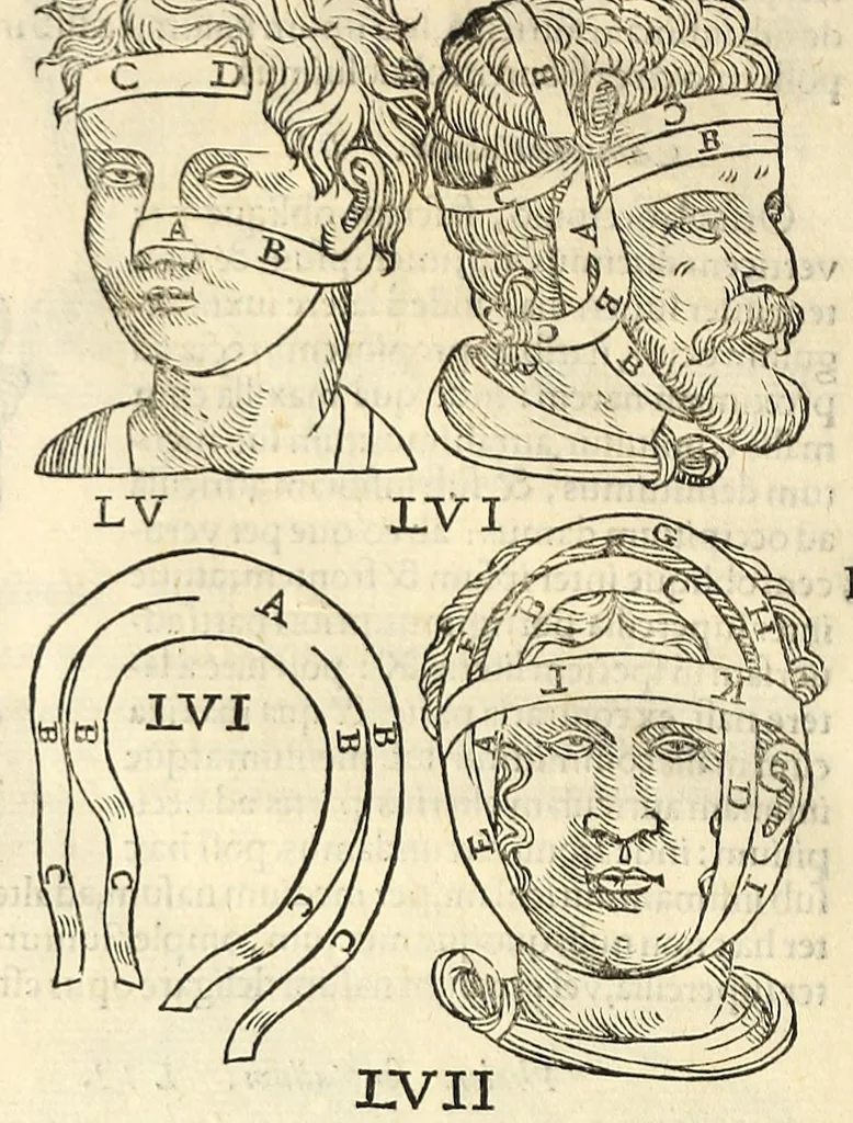 An illustration from Galeni librorum septima classis : curativum methodum tum diffuse tum breviter descriptam, victus rationem in morbis acutis, singulorum morborum facile paranda remedia, privatam quorundam morborum curationem, chirurgie constitutionem, fracturarum ac luxationum sanationem, fasciarum deniq ; & laqueorum & machinamentorum tractatum continet, 1576, leaf 620