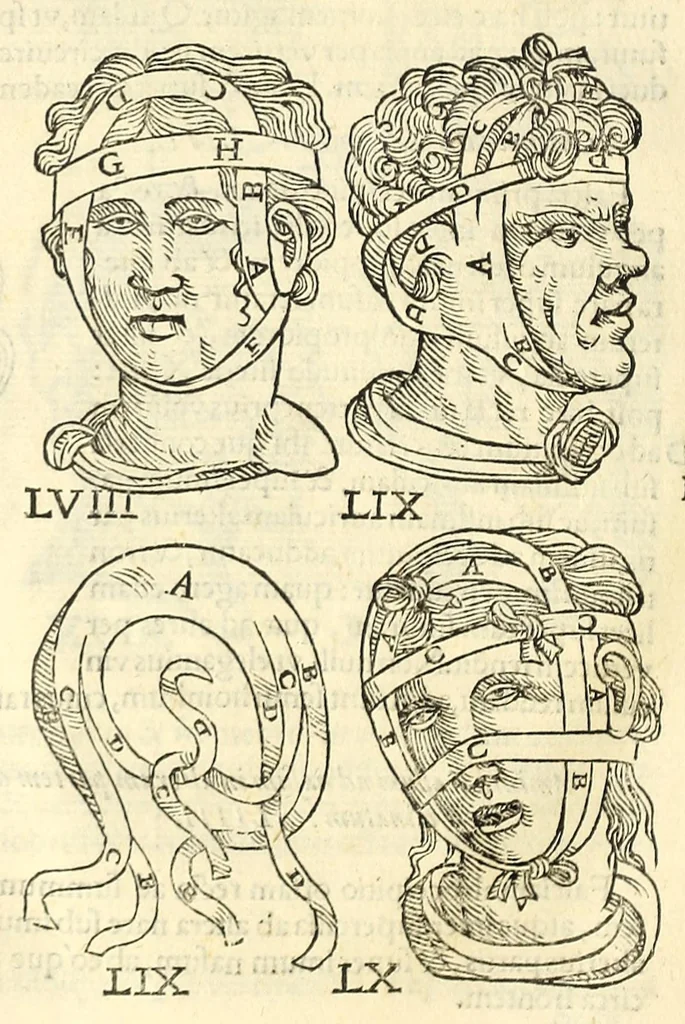 An illustration from Galeni librorum septima classis : curativum methodum tum diffuse tum breviter descriptam, victus rationem in morbis acutis, singulorum morborum facile paranda remedia, privatam quorundam morborum curationem, chirurgie constitutionem, fracturarum ac luxationum sanationem, fasciarum deniq ; & laqueorum & machinamentorum tractatum continet, 1576, leaf 620