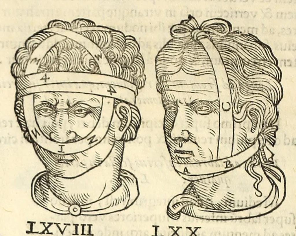 An illustration from Galeni librorum septima classis : curativum methodum tum diffuse tum breviter descriptam, victus rationem in morbis acutis, singulorum morborum facile paranda remedia, privatam quorundam morborum curationem, chirurgie constitutionem, fracturarum ac luxationum sanationem, fasciarum deniq ; & laqueorum & machinamentorum tractatum continet, 1576, leaf 622