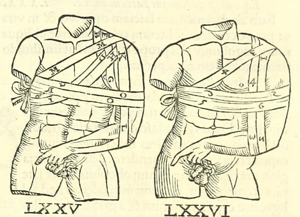 An illustration from Galeni librorum septima classis : curativum methodum tum diffuse tum breviter descriptam, victus rationem in morbis acutis, singulorum morborum facile paranda remedia, privatam quorundam morborum curationem, chirurgie constitutionem, fracturarum ac luxationum sanationem, fasciarum deniq ; & laqueorum & machinamentorum tractatum continet, 1576, leaf 623