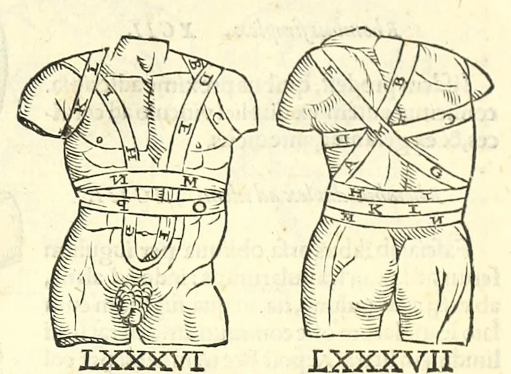An illustration from Galeni librorum septima classis : curativum methodum tum diffuse tum breviter descriptam, victus rationem in morbis acutis, singulorum morborum facile paranda remedia, privatam quorundam morborum curationem, chirurgie constitutionem, fracturarum ac luxationum sanationem, fasciarum deniq ; & laqueorum & machinamentorum tractatum continet, 1576, leaf 625