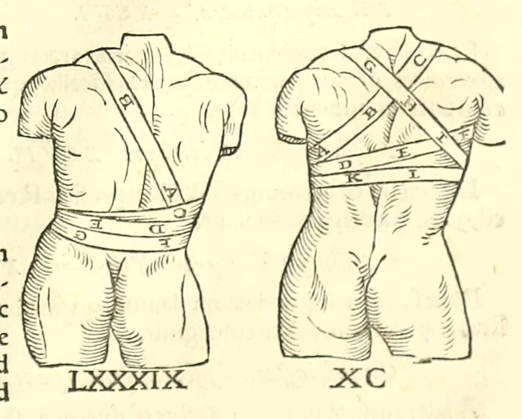 An illustration from Galeni librorum septima classis : curativum methodum tum diffuse tum breviter descriptam, victus rationem in morbis acutis, singulorum morborum facile paranda remedia, privatam quorundam morborum curationem, chirurgie constitutionem, fracturarum ac luxationum sanationem, fasciarum deniq ; & laqueorum & machinamentorum tractatum continet, 1576, leaf 625