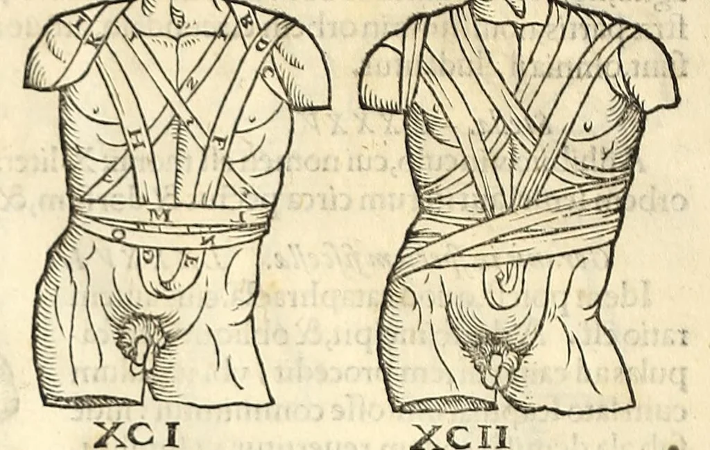 An illustration from Galeni librorum septima classis : curativum methodum tum diffuse tum breviter descriptam, victus rationem in morbis acutis, singulorum morborum facile paranda remedia, privatam quorundam morborum curationem, chirurgie constitutionem, fracturarum ac luxationum sanationem, fasciarum deniq ; & laqueorum & machinamentorum tractatum continet, 1576, leaf 626