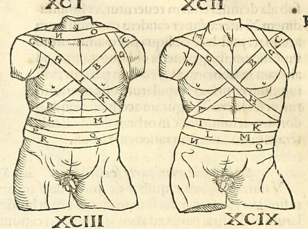 An illustration from Galeni librorum septima classis : curativum methodum tum diffuse tum breviter descriptam, victus rationem in morbis acutis, singulorum morborum facile paranda remedia, privatam quorundam morborum curationem, chirurgie constitutionem, fracturarum ac luxationum sanationem, fasciarum deniq ; & laqueorum & machinamentorum tractatum continet, 1576, leaf 626