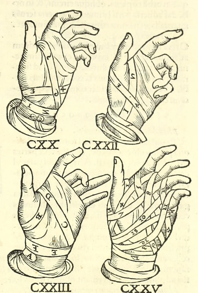 An illustration from Galeni librorum septima classis : curativum methodum tum diffuse tum breviter descriptam, victus rationem in morbis acutis, singulorum morborum facile paranda remedia, privatam quorundam morborum curationem, chirurgie constitutionem, fracturarum ac luxationum sanationem, fasciarum deniq ; & laqueorum & machinamentorum tractatum continet, 1576, leaf 631