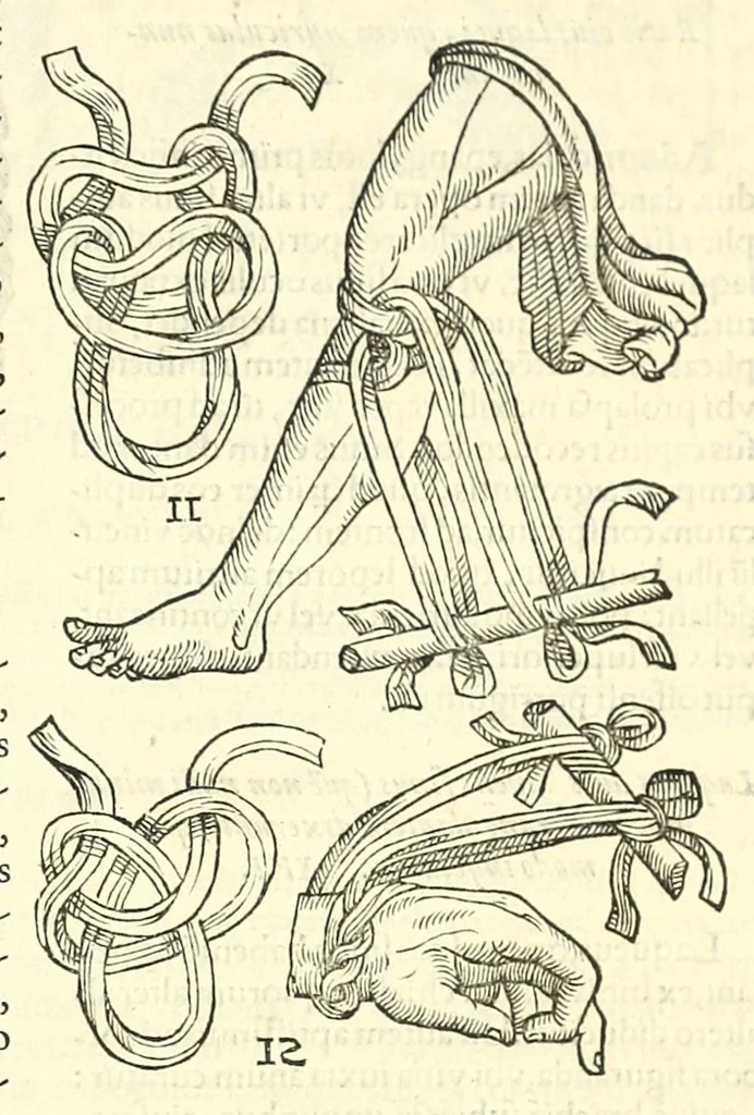 An illustration from Galeni librorum septima classis : curativum methodum tum diffuse tum breviter descriptam, victus rationem in morbis acutis, singulorum morborum facile paranda remedia, privatam quorundam morborum curationem, chirurgie constitutionem, fracturarum ac luxationum sanationem, fasciarum deniq ; & laqueorum & machinamentorum tractatum continet, 1576, leaf 637