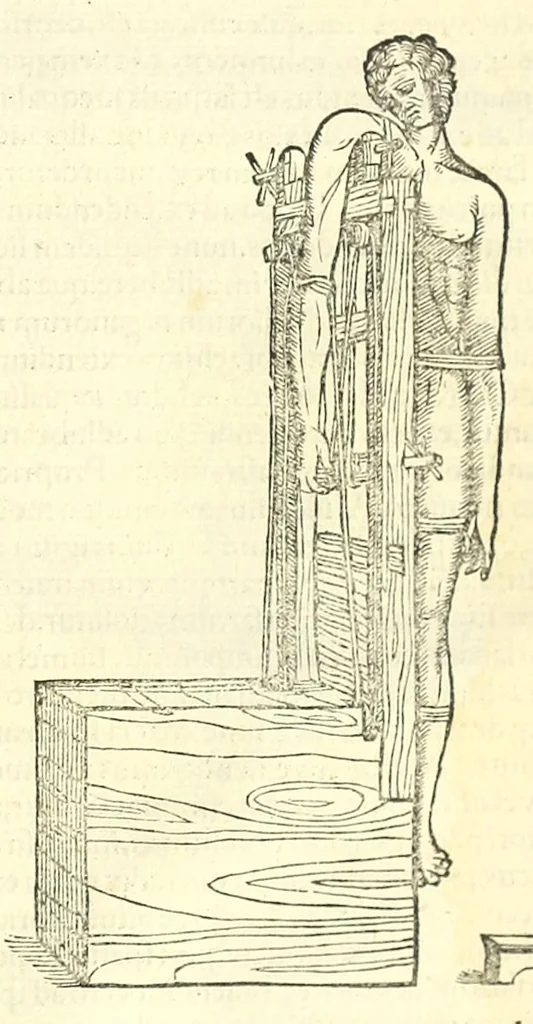 An illustration from Galeni librorum septima classis : curativum methodum tum diffuse tum breviter descriptam, victus rationem in morbis acutis, singulorum morborum facile paranda remedia, privatam quorundam morborum curationem, chirurgie constitutionem, fracturarum ac luxationum sanationem, fasciarum deniq ; & laqueorum & machinamentorum tractatum continet, 1576, leaf 657
