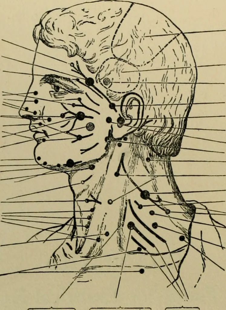 An illustration from An atlas of the differential diagnosis of the diseases of the nervous system; analytical and semeiological neurological charts, 1914, leaf 113