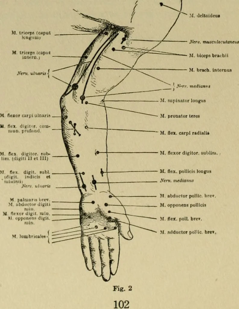 An illustration from An atlas of the differential diagnosis of the diseases of the nervous system; analytical and semeiological neurological charts, 1914, leaf 113