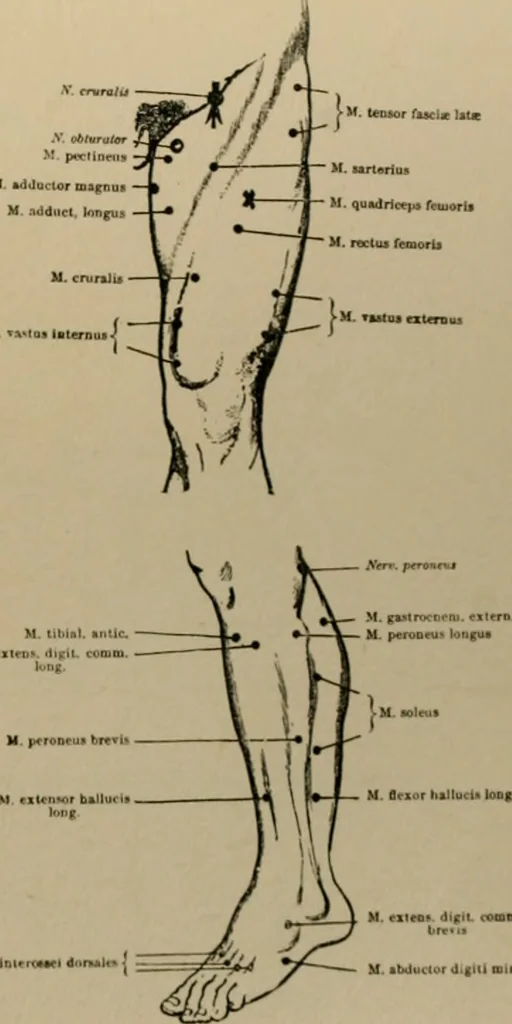 An illustration from An atlas of the differential diagnosis of the diseases of the nervous system; analytical and semeiological neurological charts, 1914, leaf 114