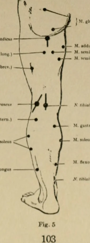 An illustration from An atlas of the differential diagnosis of the diseases of the nervous system; analytical and semeiological neurological charts, 1914, leaf 114