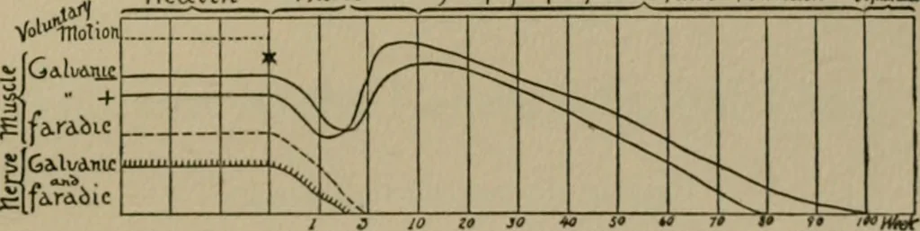 An illustration from An atlas of the differential diagnosis of the diseases of the nervous system; analytical and semeiological neurological charts, 1914, leaf 116