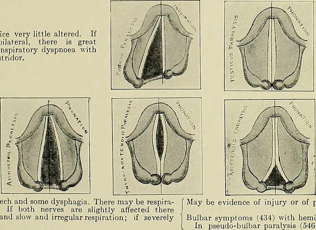 An illustration from An atlas of the differential diagnosis of the diseases of the nervous system; analytical and semeiological neurological charts, 1914, leaf 184