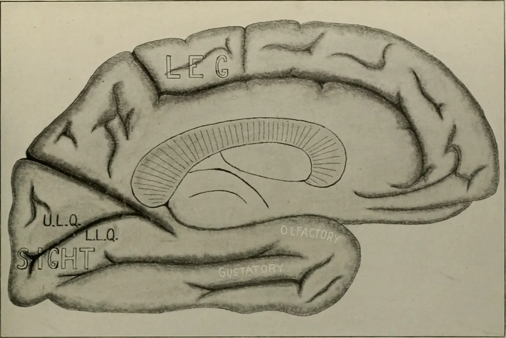 An illustration from An atlas of the differential diagnosis of the diseases of the nervous system; analytical and semeiological neurological charts, 1914, leaf 312