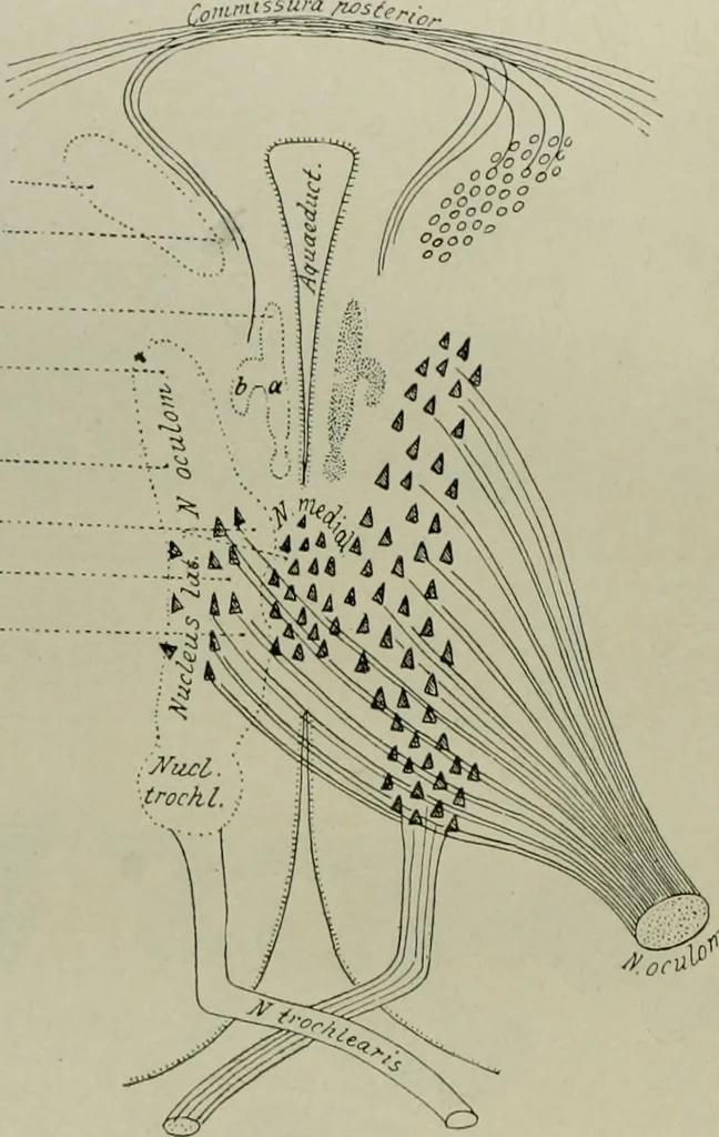 An illustration from An atlas of the differential diagnosis of the diseases of the nervous system; analytical and semeiological neurological charts, 1914, leaf 313