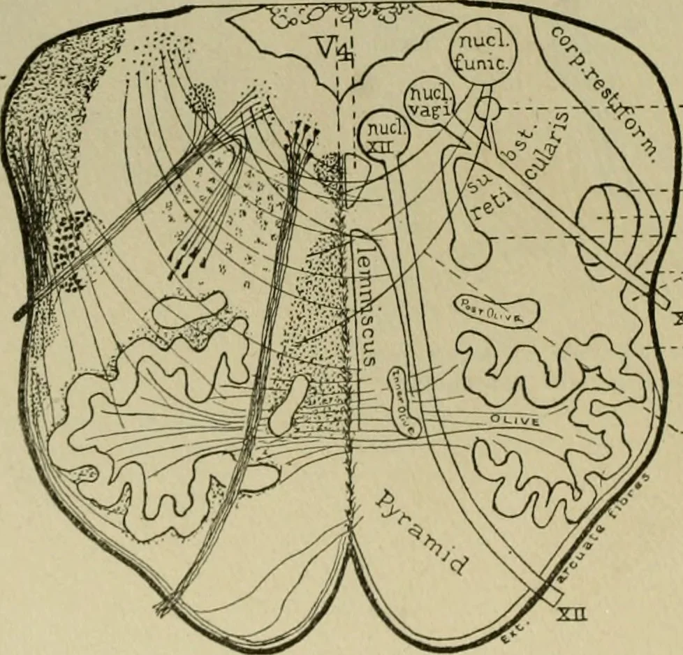 An illustration from An atlas of the differential diagnosis of the diseases of the nervous system; analytical and semeiological neurological charts, 1914, leaf 315