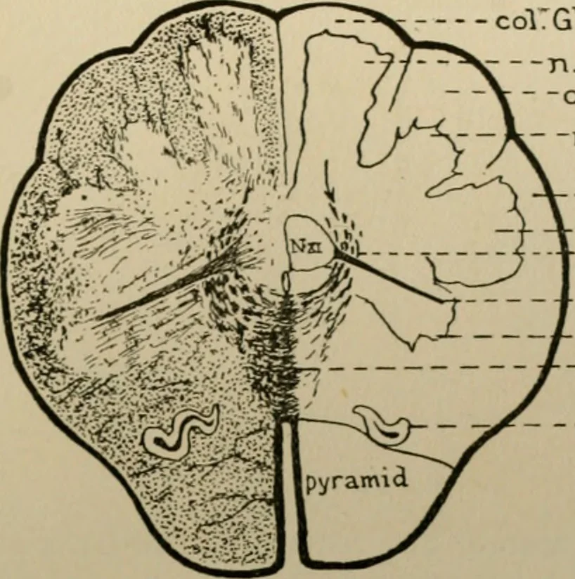 An illustration from An atlas of the differential diagnosis of the diseases of the nervous system; analytical and semeiological neurological charts, 1914, leaf 316