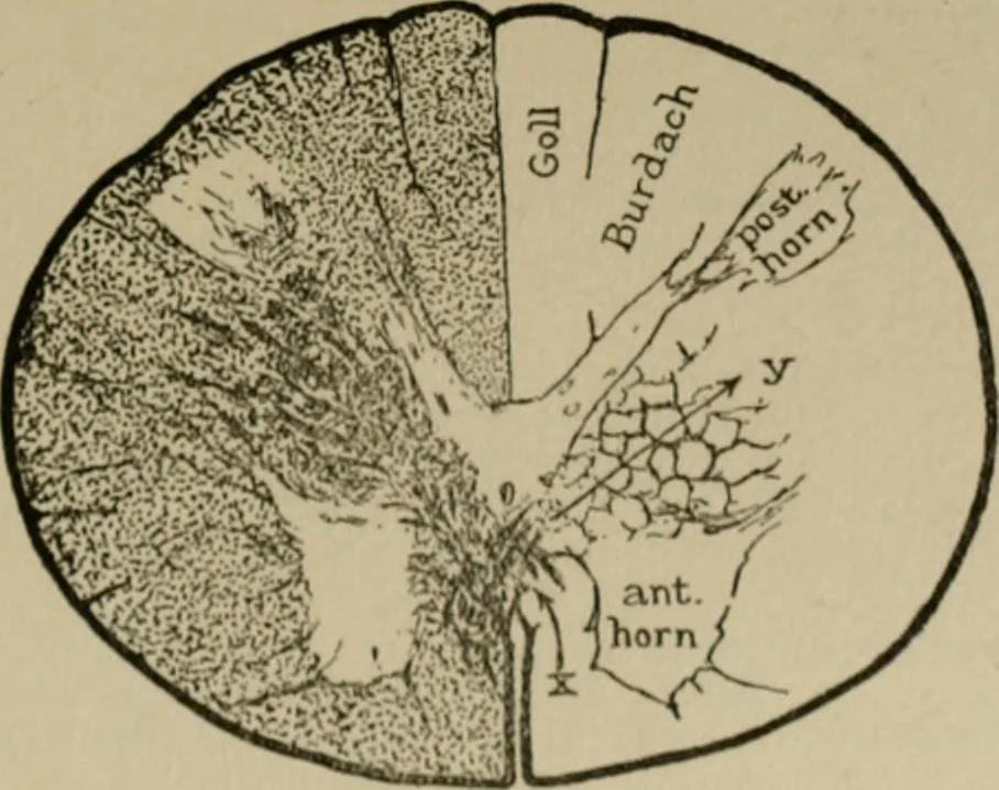 An illustration from An atlas of the differential diagnosis of the diseases of the nervous system; analytical and semeiological neurological charts, 1914, leaf 316