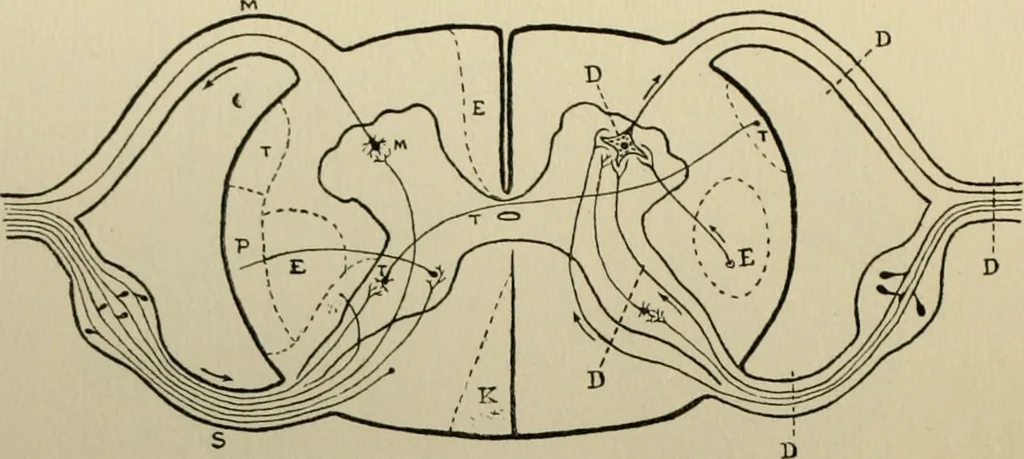 An illustration from An atlas of the differential diagnosis of the diseases of the nervous system; analytical and semeiological neurological charts, 1914, leaf 317