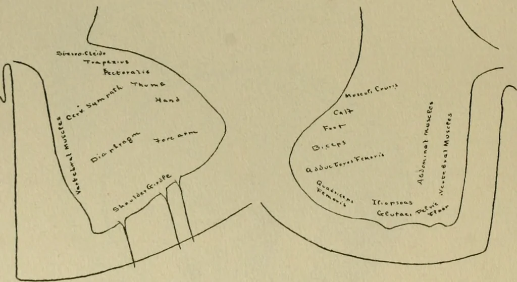 An illustration from An atlas of the differential diagnosis of the diseases of the nervous system; analytical and semeiological neurological charts, 1914, leaf 317