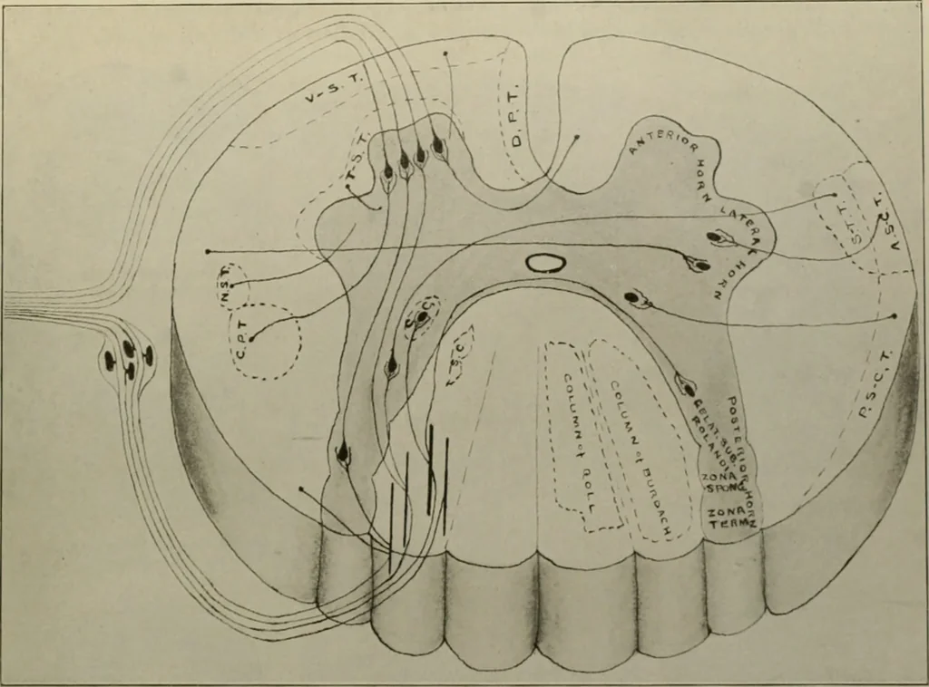 An illustration from An atlas of the differential diagnosis of the diseases of the nervous system; analytical and semeiological neurological charts, 1914, leaf 318