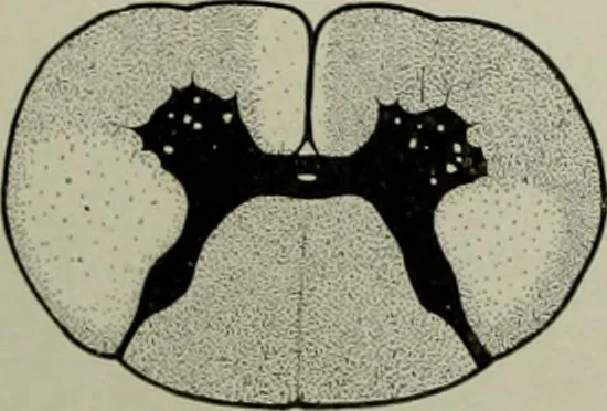 An illustration from An atlas of the differential diagnosis of the diseases of the nervous system; analytical and semeiological neurological charts, 1914, leaf 319