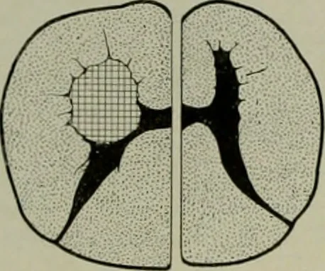 An illustration from An atlas of the differential diagnosis of the diseases of the nervous system; analytical and semeiological neurological charts, 1914, leaf 319