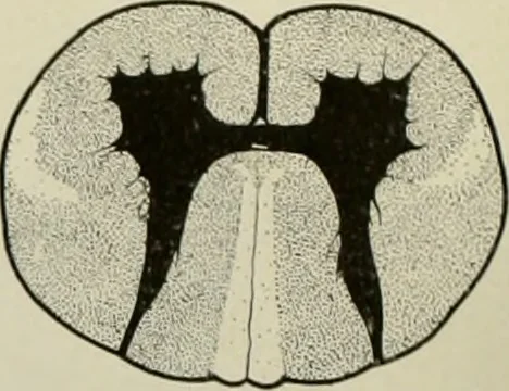 An illustration from An atlas of the differential diagnosis of the diseases of the nervous system; analytical and semeiological neurological charts, 1914, leaf 319