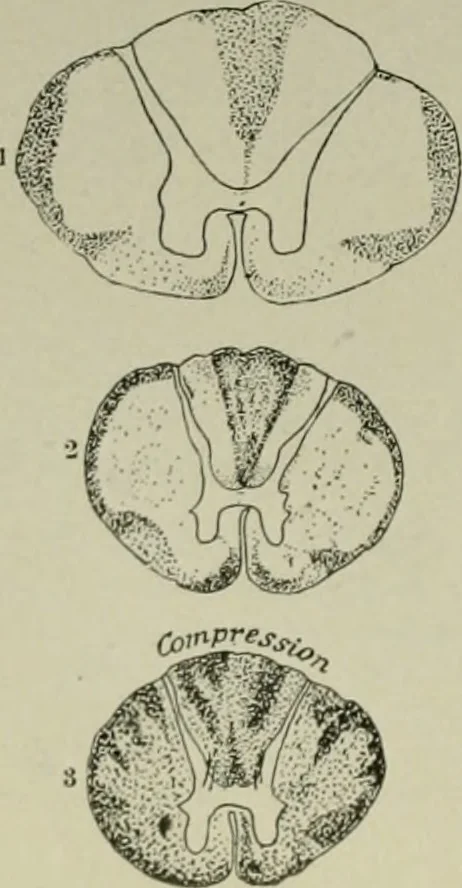 An illustration from An atlas of the differential diagnosis of the diseases of the nervous system; analytical and semeiological neurological charts, 1914, leaf 319