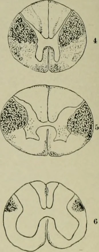 An illustration from An atlas of the differential diagnosis of the diseases of the nervous system; analytical and semeiological neurological charts, 1914, leaf 319