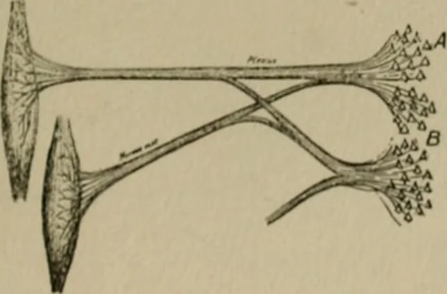 An illustration from An atlas of the differential diagnosis of the diseases of the nervous system; analytical and semeiological neurological charts, 1914, leaf 320
