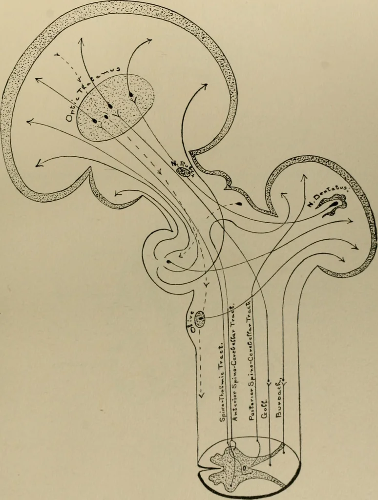 An illustration from An atlas of the differential diagnosis of the diseases of the nervous system; analytical and semeiological neurological charts, 1914, leaf 324